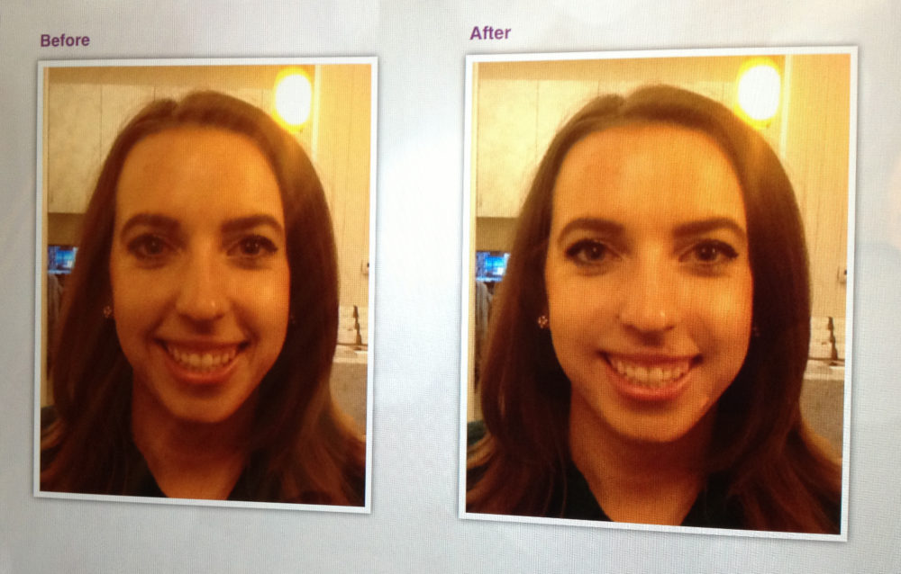 SkinSpirit Juvederm Simulator App