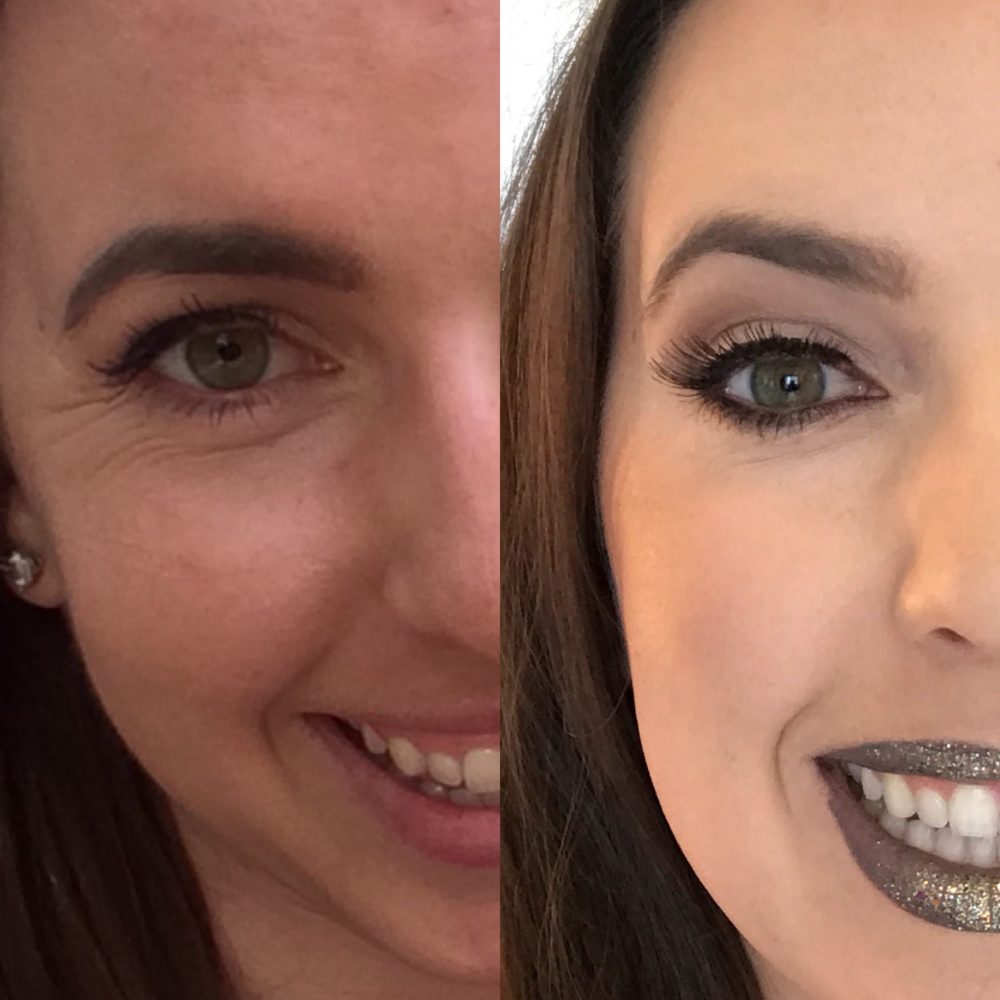 crows feet botox before and after