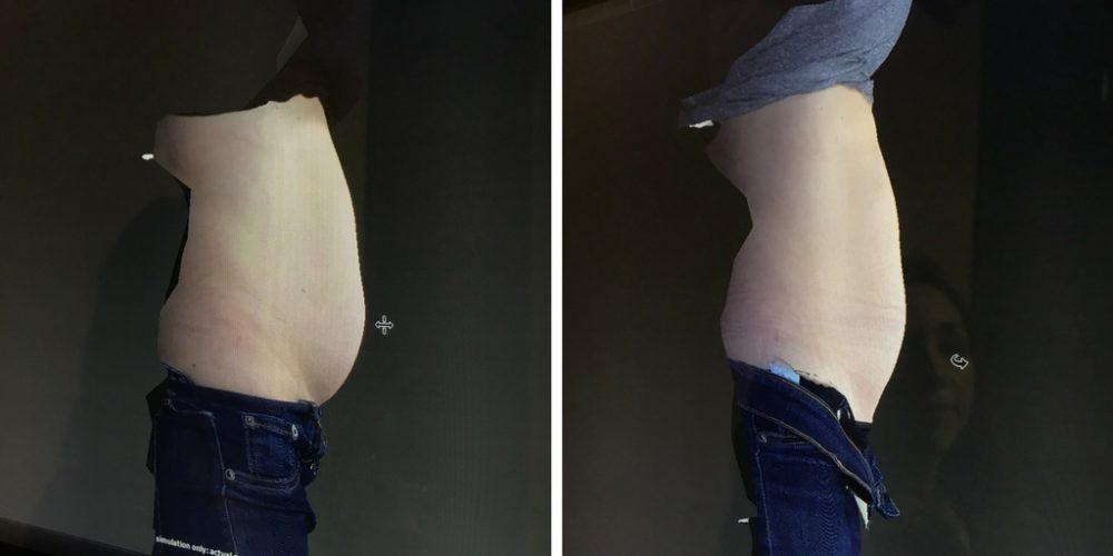 CoolSculpting Before & After - Side View