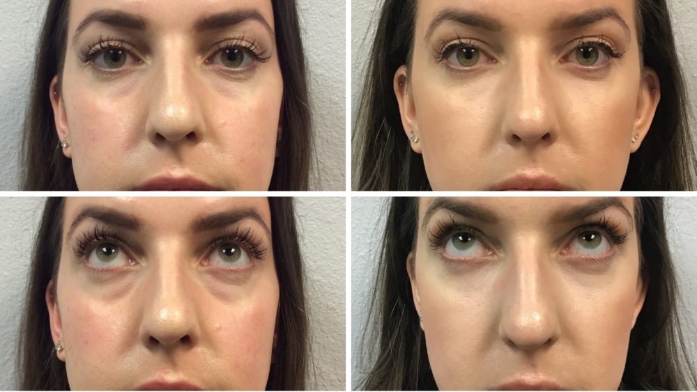 Under Eye Filler Before & After