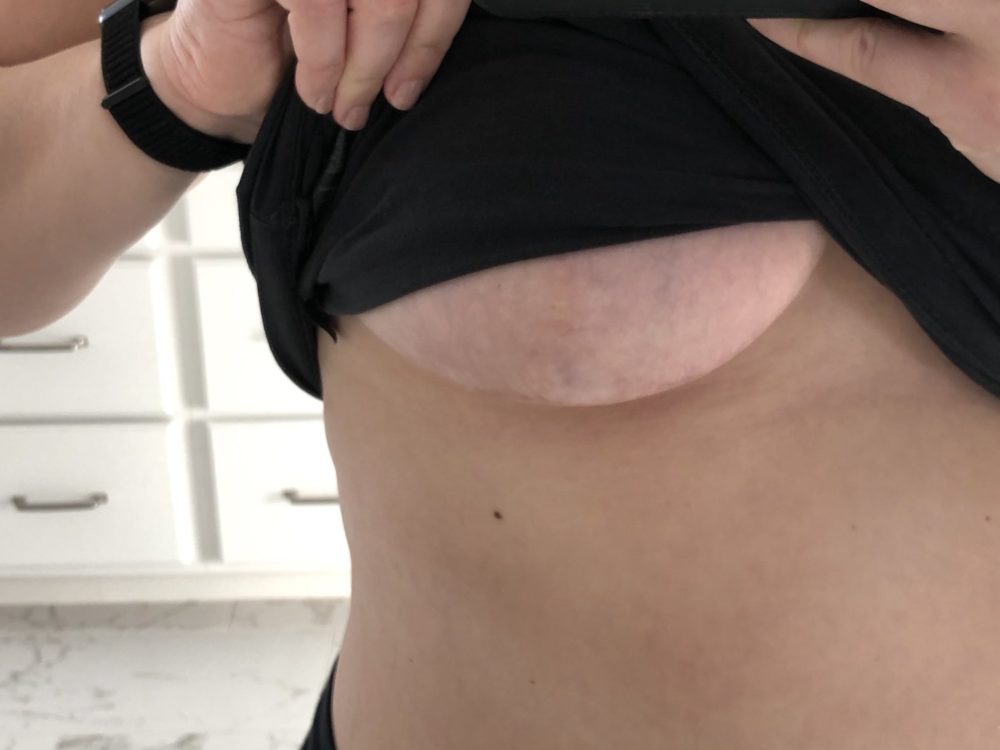 Breast Reduction Anchor Scar After 1 Year
