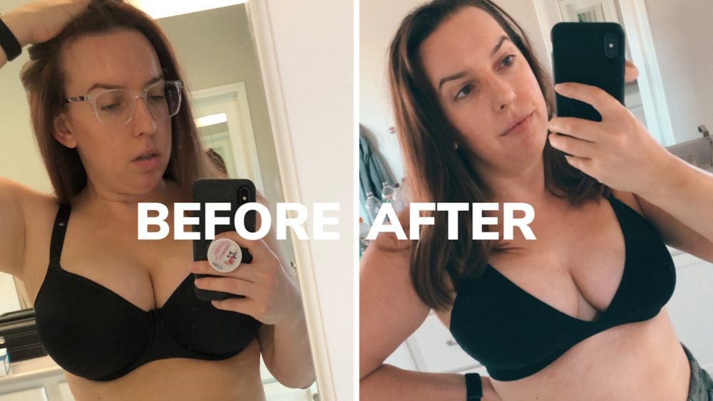 Breast Reduction Before and After - Front
