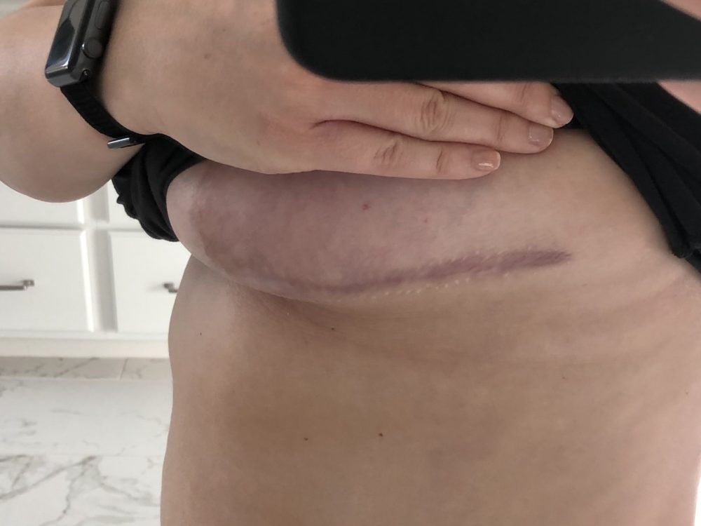 Breast Reduction Scars After 1 Year