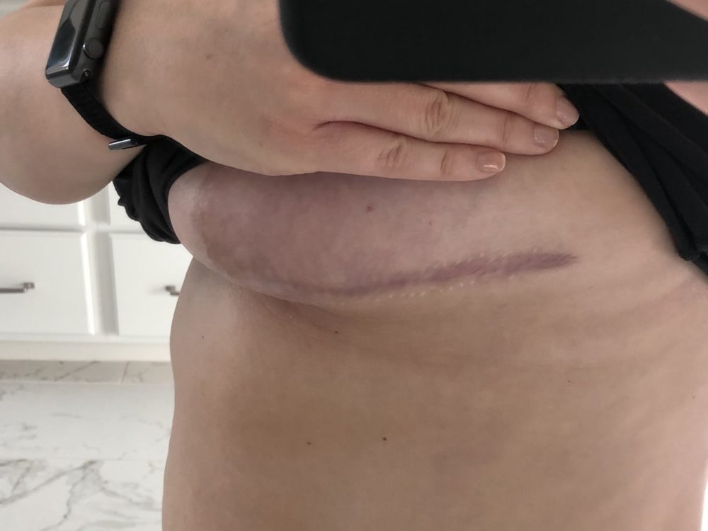 What Will My Scars Look Like After Breast Lift Surgery?