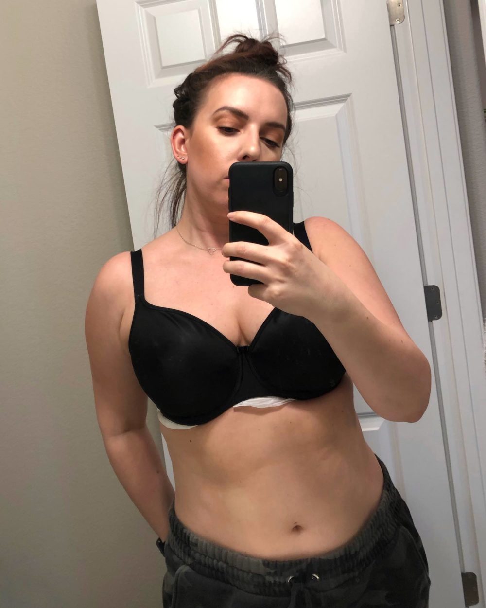 Breast Reduction Surgery 1 Month Post Op @chelseapearl