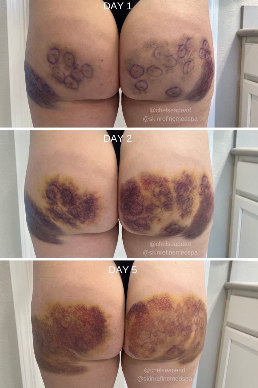 Qwo Cellulite Treatment - 2nd Treatment Bruising