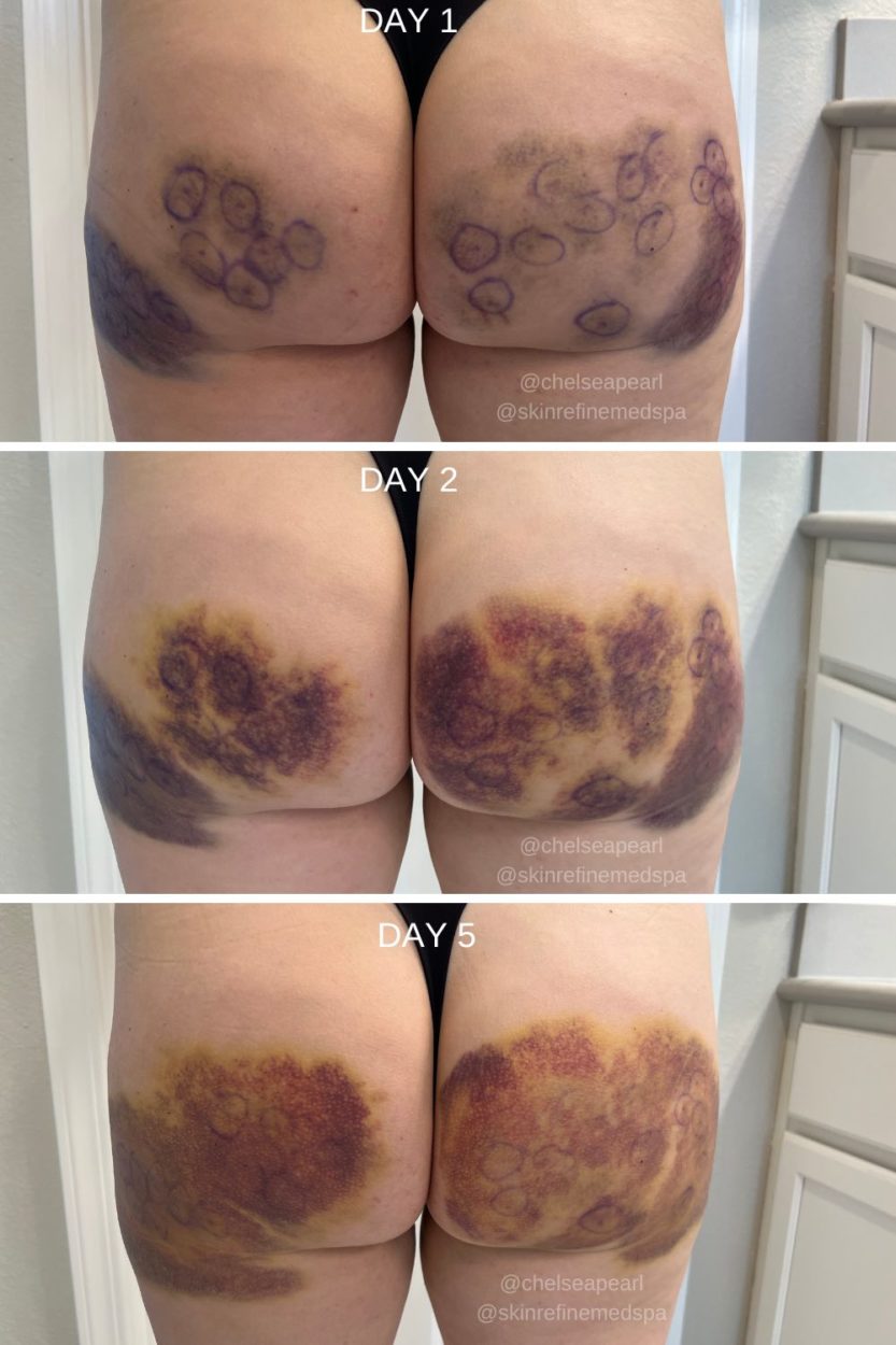 All About Qwo Cellulite Treatment  Before and After Results, Cost