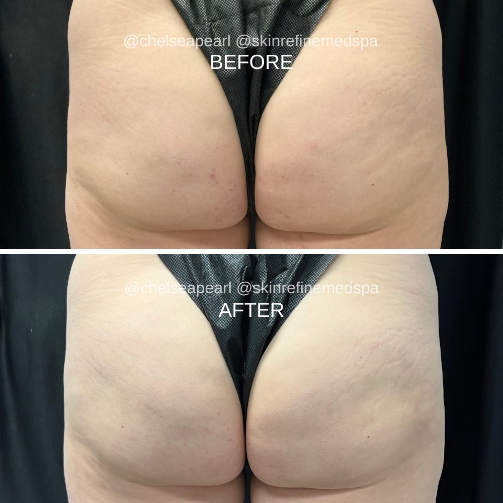 Qwo Cellulite Treatment Before and After
