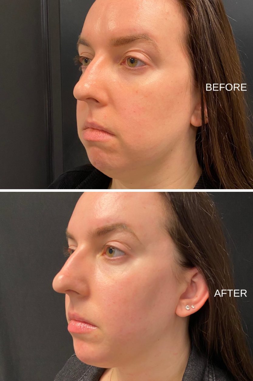 RHA Filler - Cheek and Chin Filler - Before and After