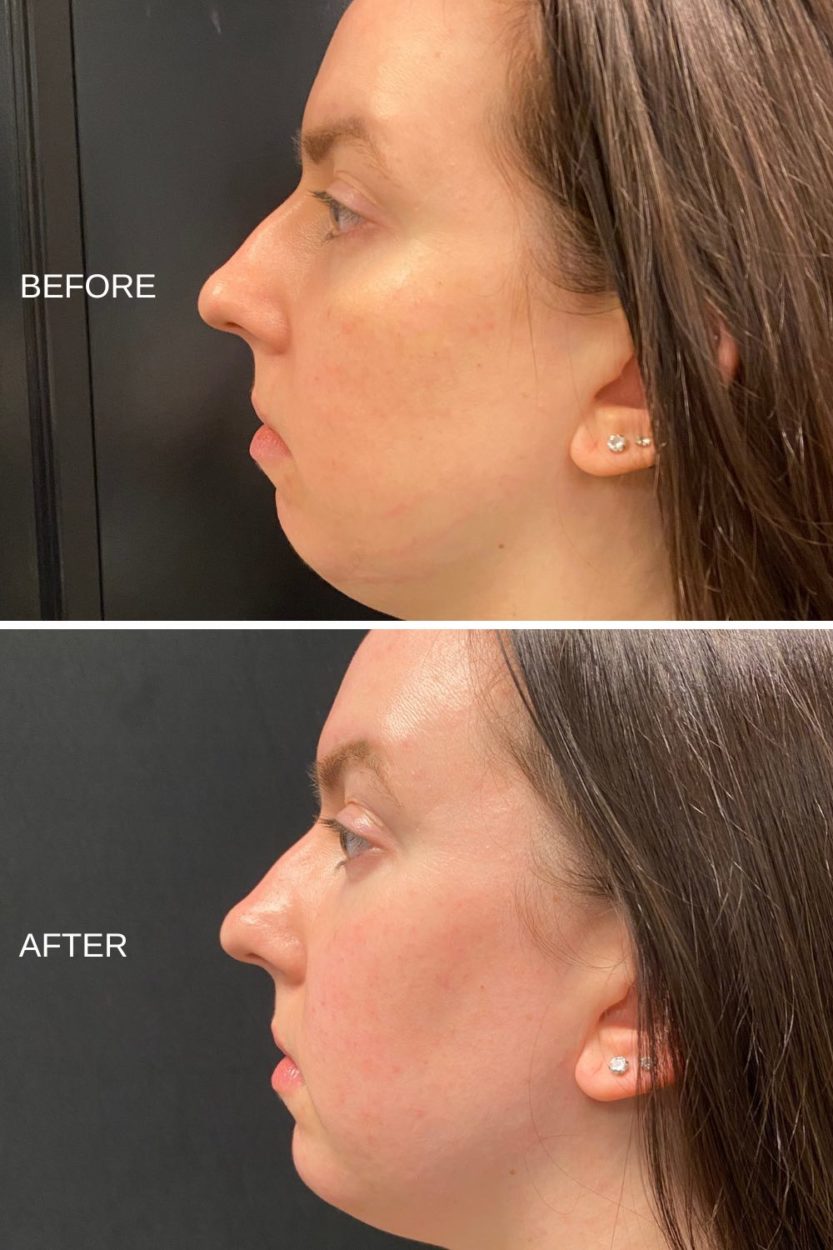 RHA Filler - Left Side Profile Before and After