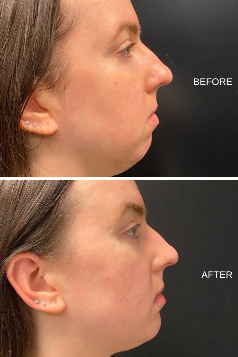 RHA Filler - Right Side Profile Before and After